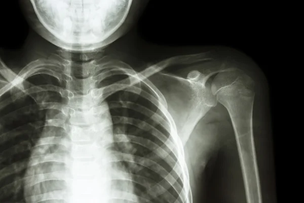 Film x-ray left shoulder — Stock Photo, Image