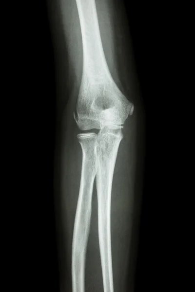 Film x-ray elbow AP : show normal human's  elbow — Stock Photo, Image