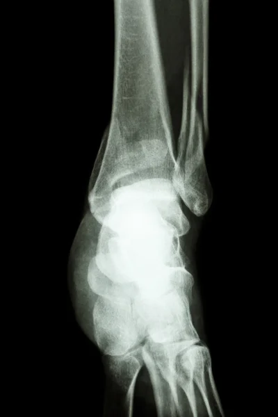 Перелом дистальної великогомілкової кістки та малогомілкової кістки (кістки ноги ) — стокове фото