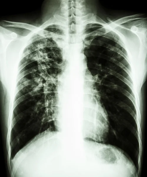 Tuberculosis pulmonar — Foto de Stock