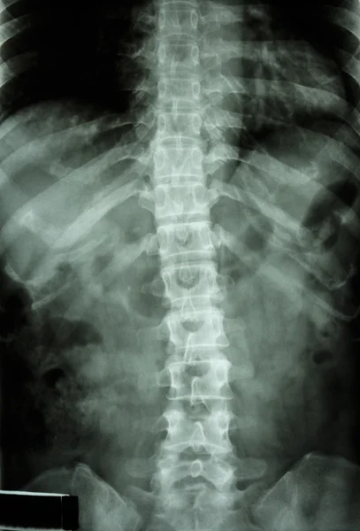 Normal human's thoracic-lumbar spine — Stock Photo, Image