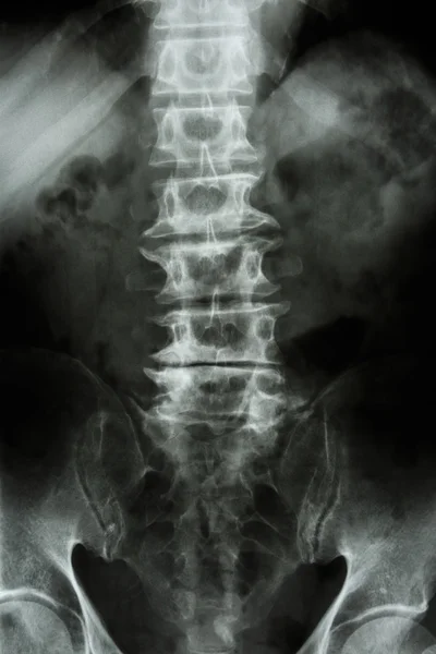 Spondylosis — Stock Photo, Image