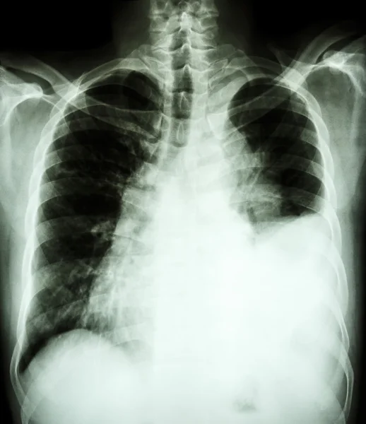 Pleural effusion at left lung due to lung cancer — Stock Photo, Image