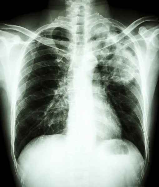 Mycobacterium tuberculosis infection (Pulmonary Tuberculosis) — Stock Photo, Image