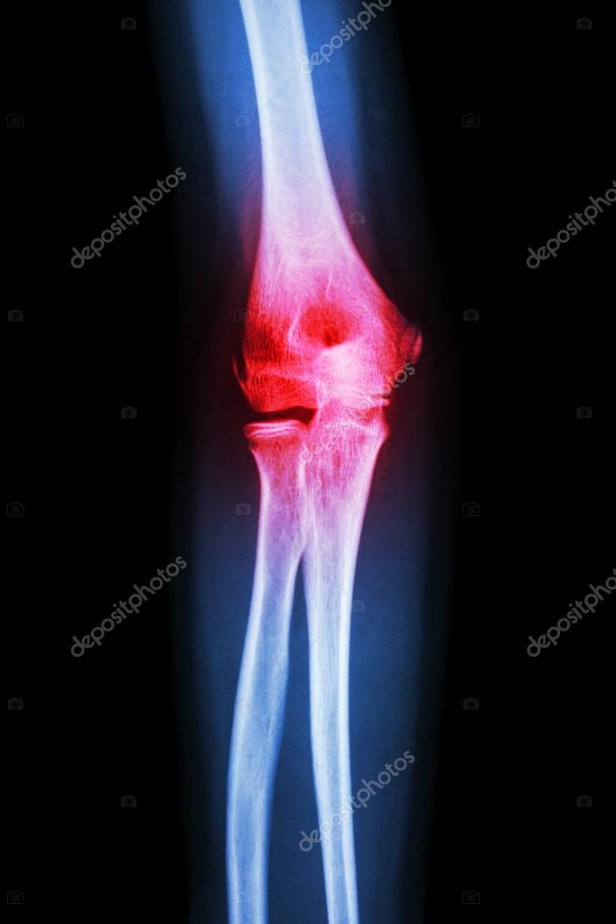 Xray human's elbow and arthritis (Gout , Rheumatoid) Stock Photo by