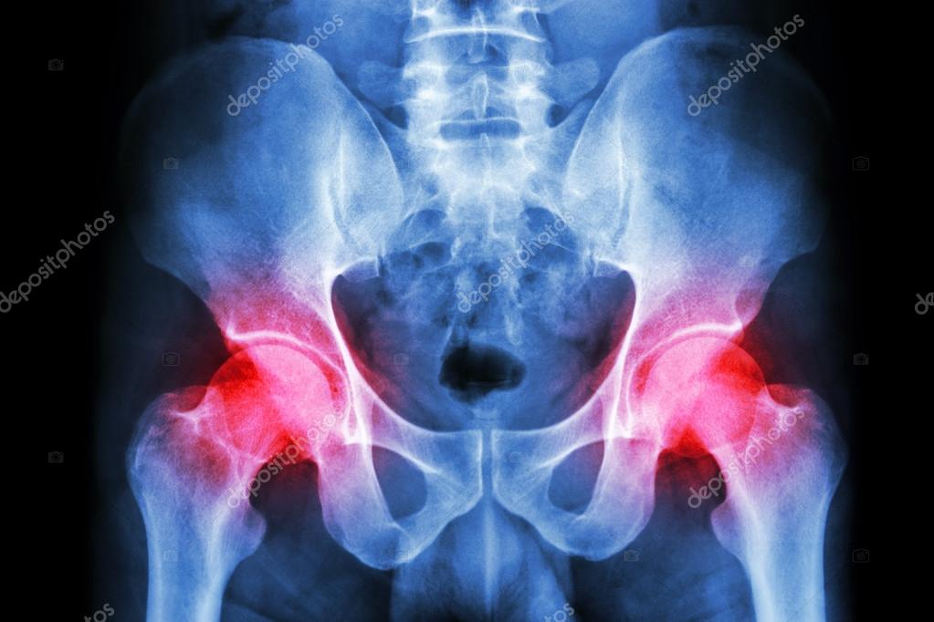 3-4 csípőízületi osteoarthritis