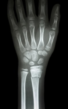fracture distal radius (forearm's bone) clipart