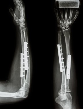 fracture shaft of radius & ulnar bone. It was operated and inter clipart
