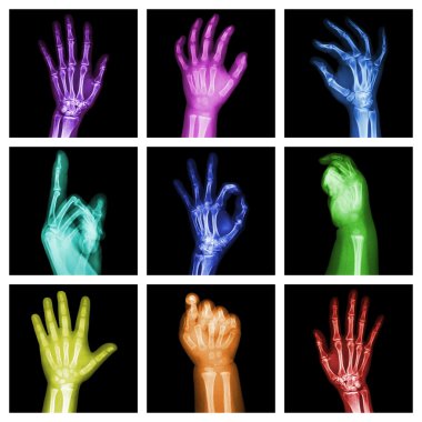 Renkli x-ray eller topluluğu