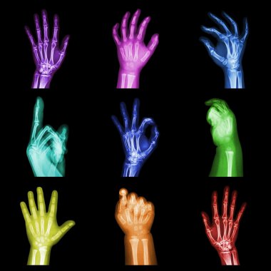 Renkli x-ray eller topluluğu