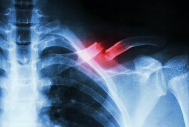 Fracture left clavicle clipart