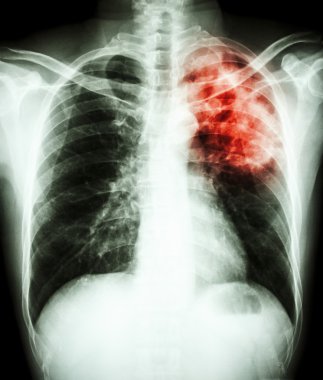 Mycobacterium tüberküloz enfeksiyonu (akciğer tüberkülozu)