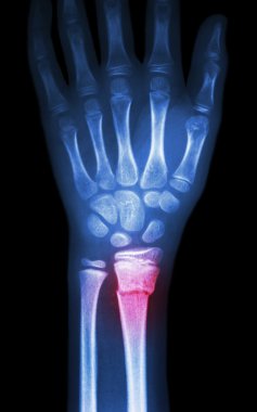 distal radyus (önkol'ın kemik kırığı)