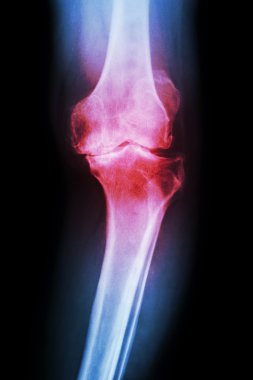 Osteoartrit diz hasta