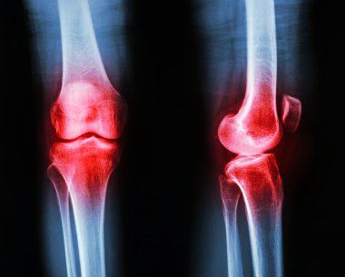 Film x-ışını diz Ap, lateral: osteoartrit diz (iltihap, diz)
