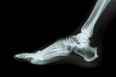 X-ray normal foot lateral clipart