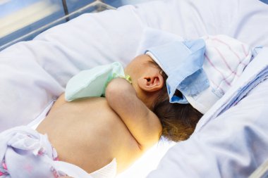 Neonatal jaundice clipart