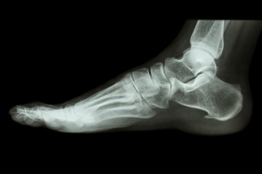 Normal insanın ayak lateral x-ışını