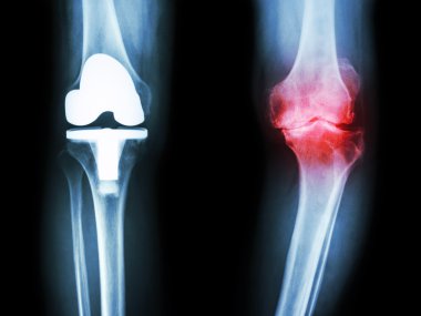 Film x-ışını diz osteoartrit diz sabırlı ve yapay eklem