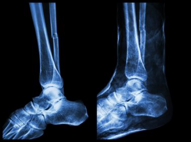 Sol görüntü: kırık kaval (buzağı kemik) mili, tam görüntü: alçı ile splinted yapıldı.
