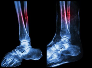 Sol görüntü: kırık kaval (buzağı kemik) mili, tam görüntü: alçı ile splinted yapıldı.