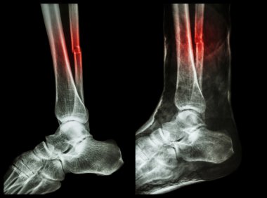 Sol görüntü: kırık kaval (buzağı kemik) mili, tam görüntü: alçı ile splinted yapıldı.