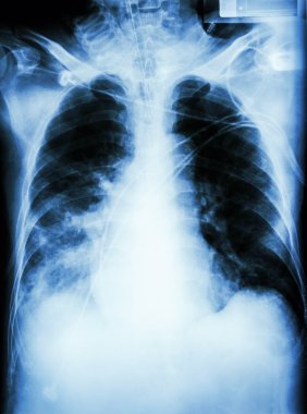Pneumonia with respiratory failure clipart