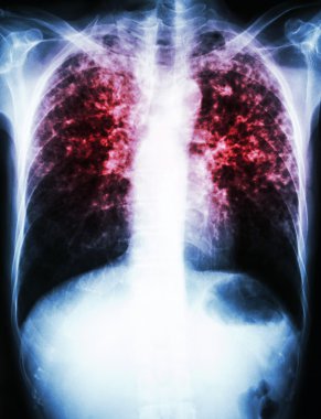 Mycobacterium tüberküloz enfeksiyonu (akciğer tüberkülozu)