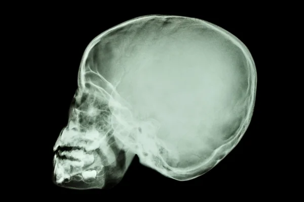 Crâne d'enfant asiatique (peuple thaïlandais ) — Photo