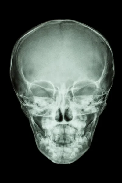 Normal thai child's skull — Stock Photo, Image