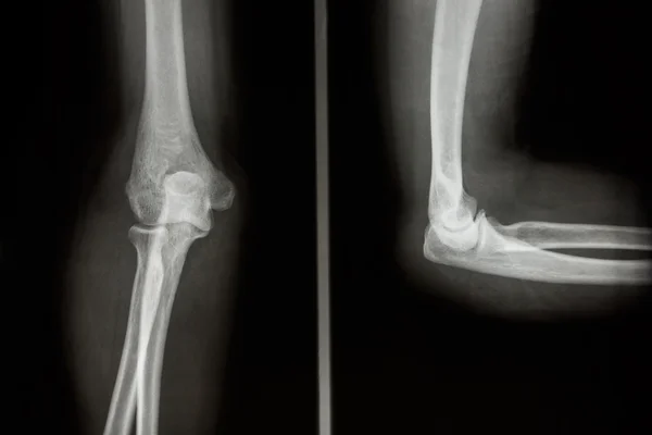 Normal human 's elbow — стоковое фото