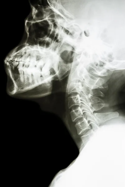 Coluna cervical do homem tailandês normal — Fotografia de Stock