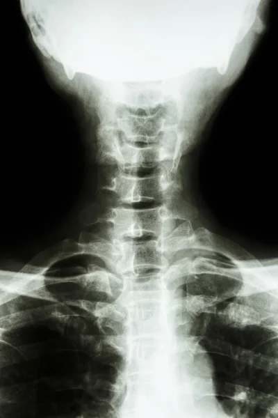 Normal thai man's cervical spine — Stock Photo, Image