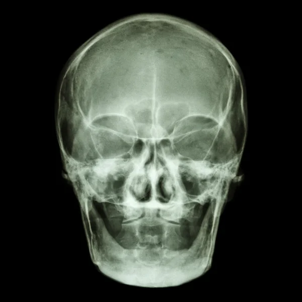 Normal old aged asian skull (Thai people),(no tooth) — Stock Photo, Image