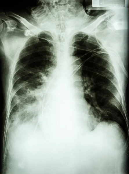 Pneumonie avec insuffisance respiratoire — Photo