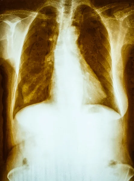 Old and dirty film chest x-ray of adult — Stock Photo, Image
