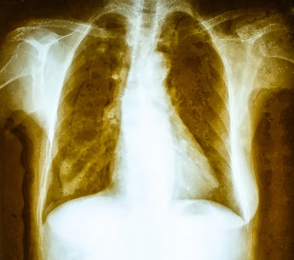 Old and dirty film chest x-ray of adult — Stock Photo, Image