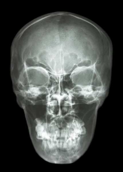 Asian's skull (Thai people) — Stock Photo, Image