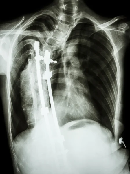 Scoliosis patient was operated and internal fixed at thoracic sp — Stock Photo, Image