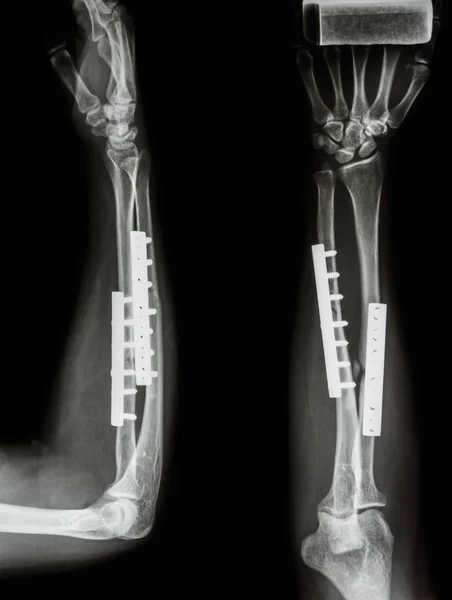 Fracture shaft of radius & ulnar bone. It was operated and inter — Stock Photo, Image