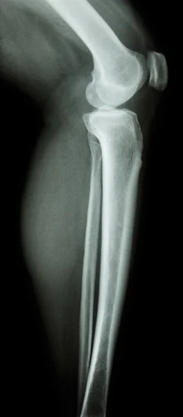 Normal human 's knee & leg — стоковое фото