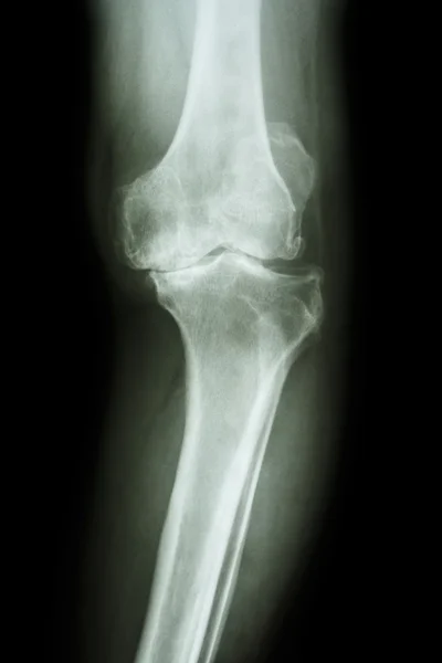 Artróza kolene pacient — Stock fotografie