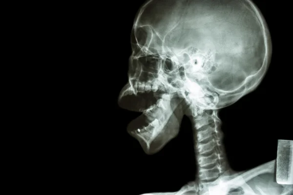 X-ray crâne asiatique et bouche ouverte — Photo