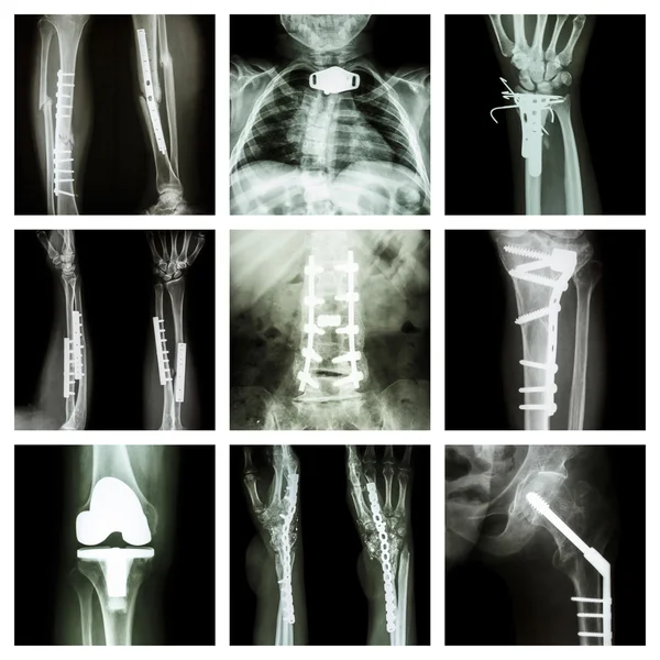 Raccolta di interventi ortopedici — Foto Stock