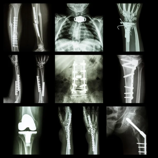 Collection of orthopedic operation — Stock Photo, Image