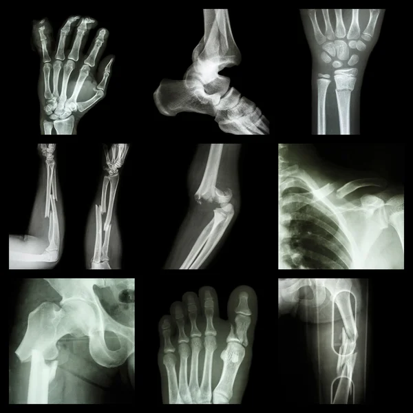 Collection of bone fracture — Stock Photo, Image