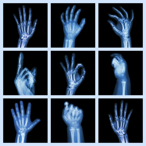 Röntgenaufnahme der Hände — Stockfoto
