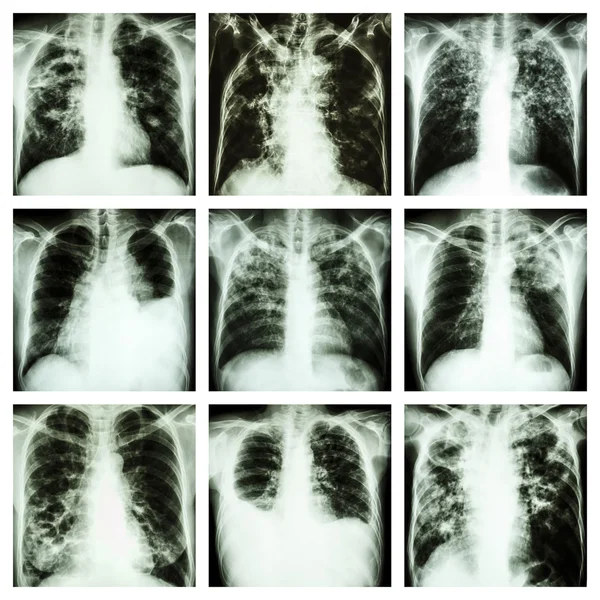 Collection of lung disease (Pulmonary tuberculosis,Pleural effusion,Bronchiectasis) — Stock Photo, Image