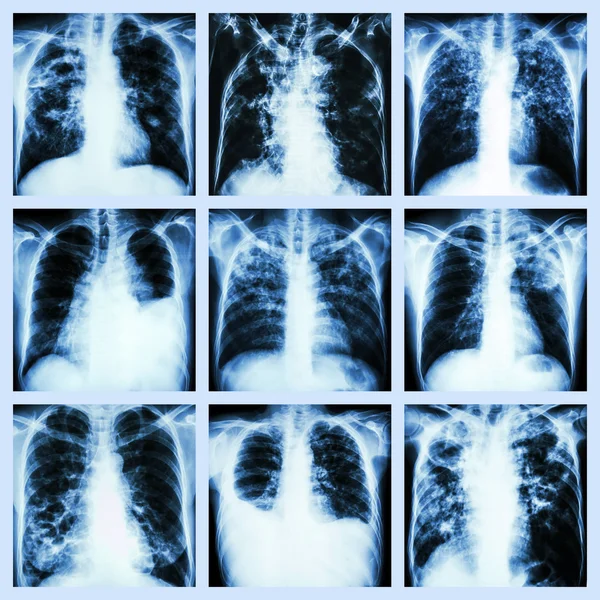 Enfermedad pulmonar (tuberculosis pulmonar, derrame pleural, bronquiectasias) ) — Foto de Stock