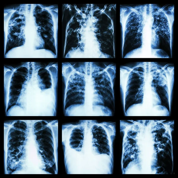 Collection of lung disease (Pulmonary tuberculosis,Pleural effusion,Bronchiectasis) — Stock Photo, Image